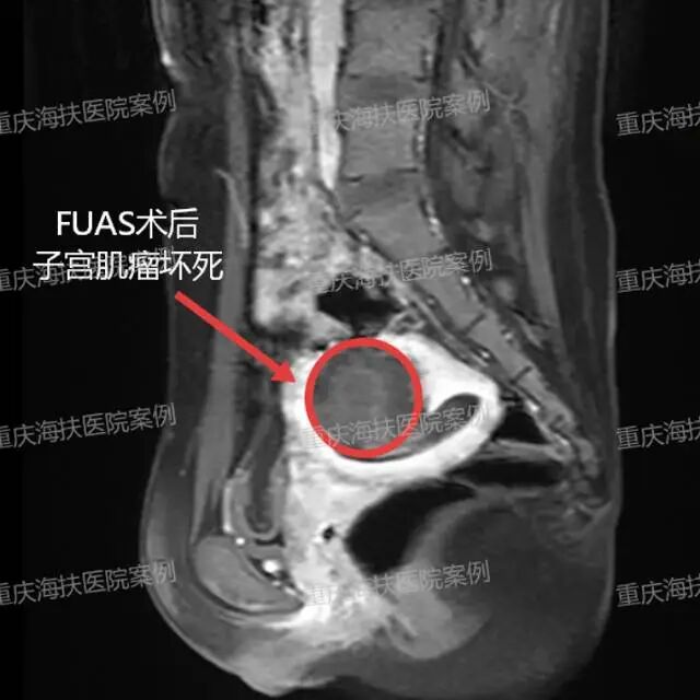 花季遇肌瘤，重庆海扶医院无创护芳华