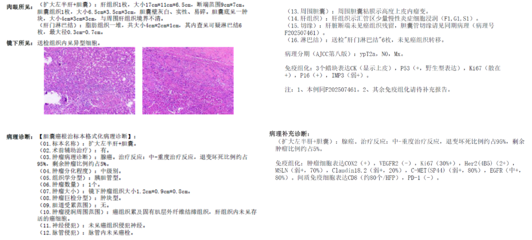 破局胆道癌：从「晚期不可切」到「根治性手术」的生命奇迹