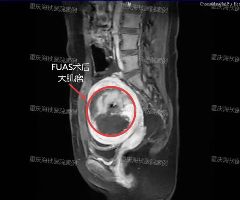 17 岁少女的无创肌瘤诊疗纪实