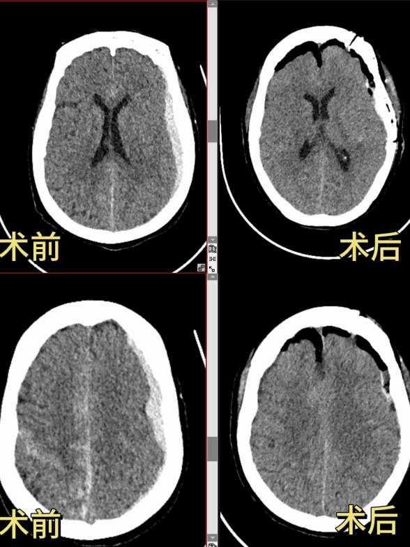七旬高危患者命悬一线！桂医大二附院救治脑动脉瘤破裂合并重症心衰老人