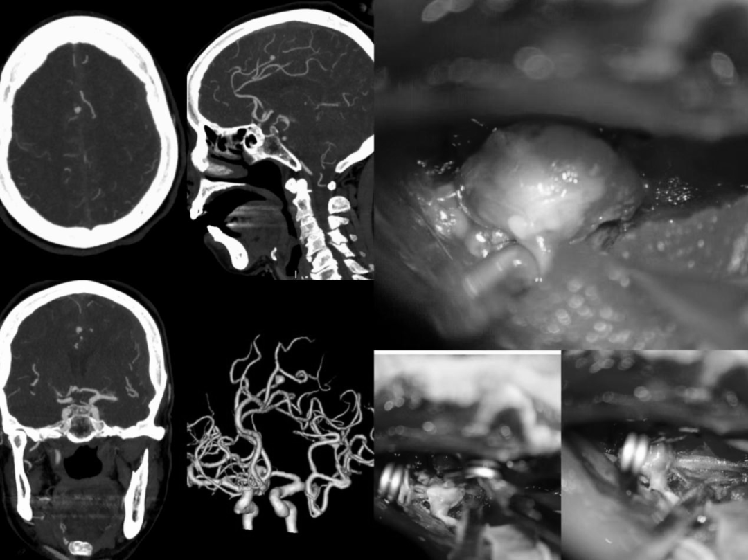 七旬高危患者命悬一线！桂医大二附院救治脑动脉瘤破裂合并重症心衰老人