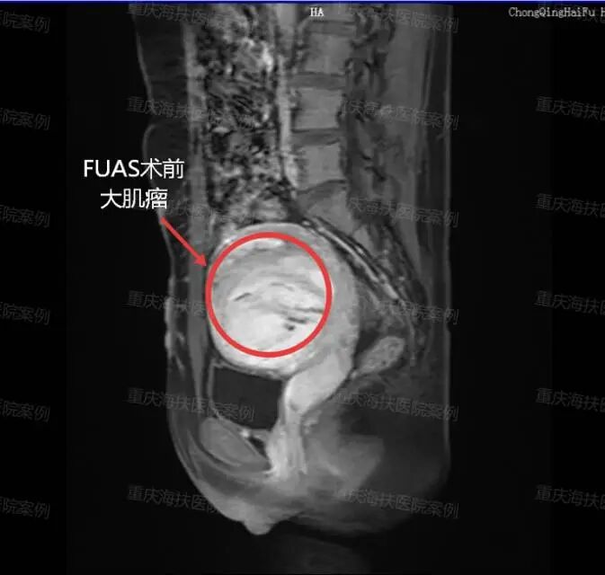 17 岁少女的无创肌瘤诊疗纪实