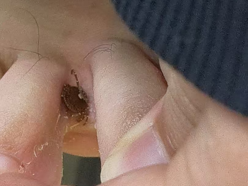 15 岁少年脚趾缝冒「黑痣」，医生提醒：千万别硬拔！