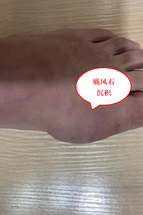 一伸手全是「疙瘩」！别慌，坚持做好 4 件事，关节也能做「美容」！