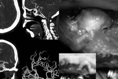 七旬高危患者命悬一线！桂医大二附院救治脑动脉瘤破裂合并重症心衰老人