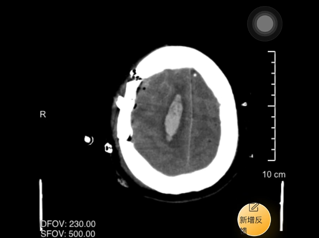 南京健华康复医院助 56 岁脑出血患者重获行走自由