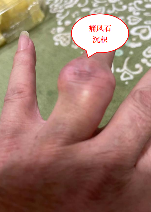 一伸手全是「疙瘩」！别慌，坚持做好 4 件事，关节也能做「美容」！