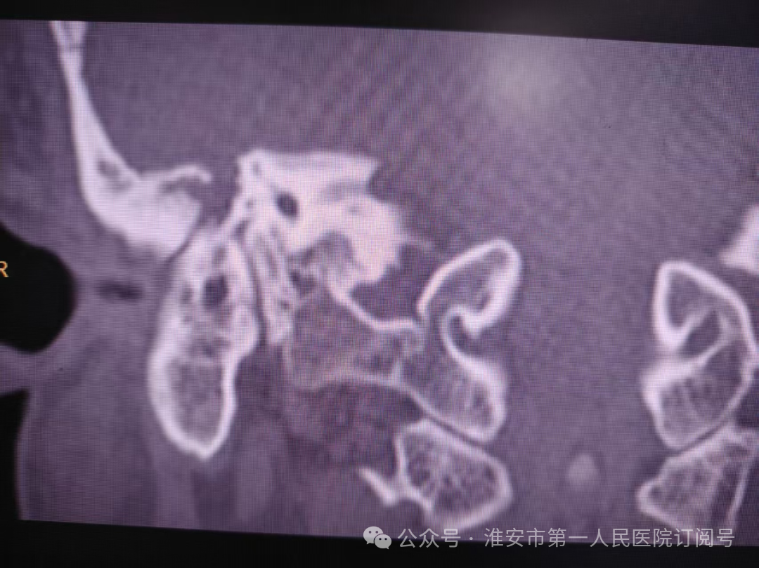 吃饭漏饭 说话漏风！淮安市一院耳鼻喉科成功救治严重创伤性面瘫患者