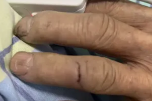 老鼠咬伤也致命？小心这种罕见病！