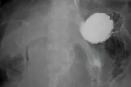 不用开腹、仅需 30 分钟！这项内镜技术，如何为消化道「重启通路」？