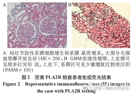 8 例儿童 IgA 肾病合并膜性肾病的临床病理学特征及预后分析：回顾性病例系列报告