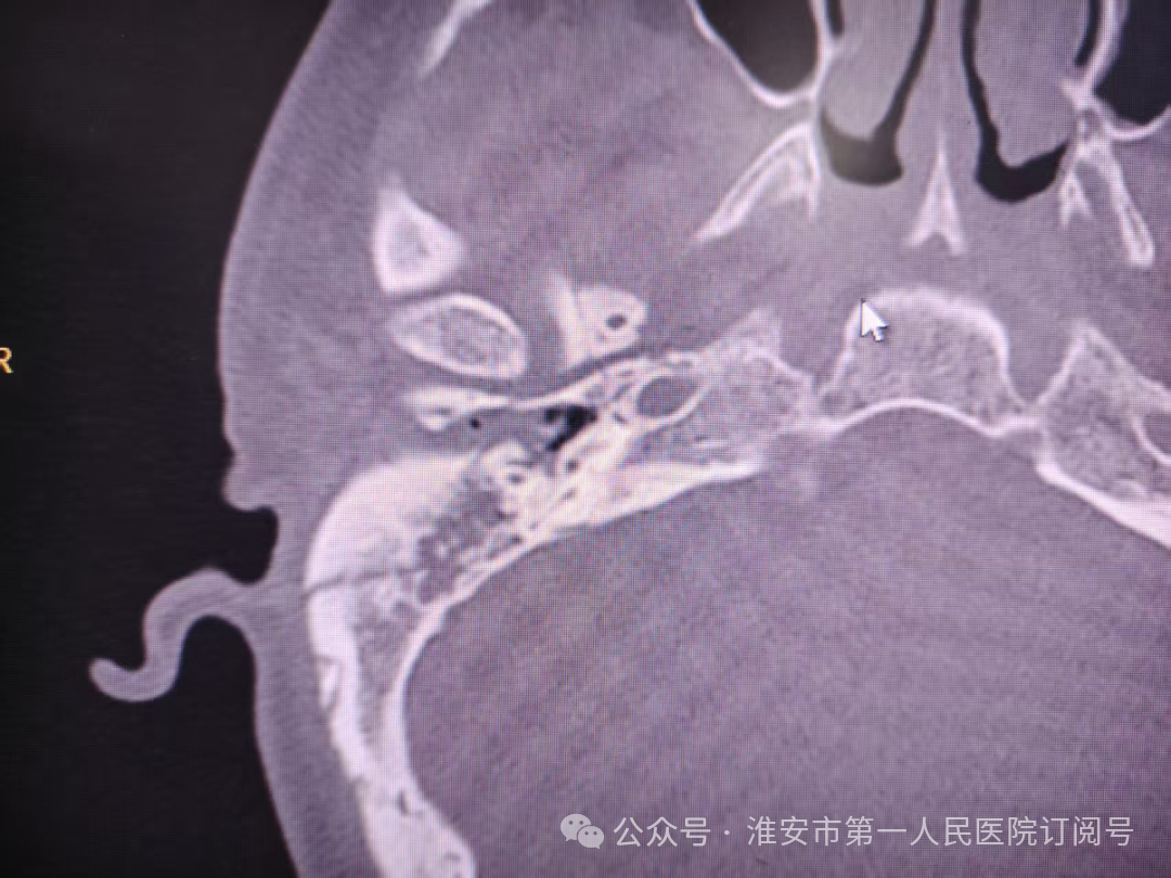 吃饭漏饭 说话漏风！淮安市一院耳鼻喉科成功救治严重创伤性面瘫患者