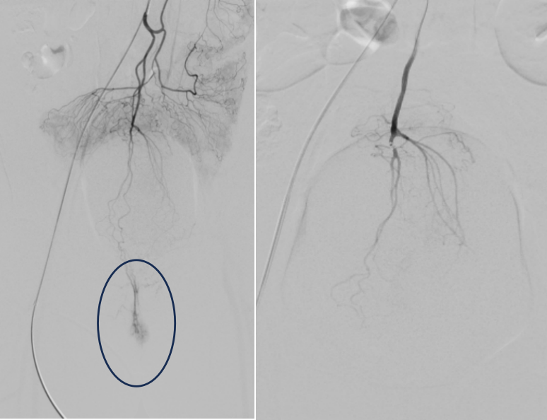 浙大四院这个新科室，专门在肿瘤和血管里「穿针引线」