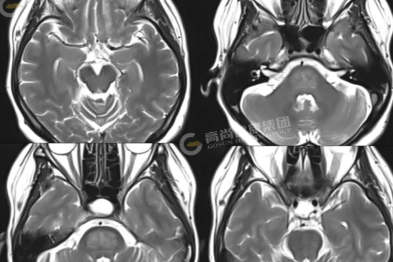 【高尚病例】脑桥中央髓鞘溶解症