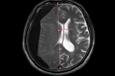 古稀老人跌倒后忽视颅伤，颅内「淤血」渐袭！神经内镜「清淤」，精准破危局