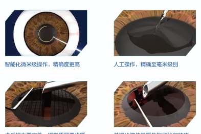 白内障手术进入「无刀」新时代——周衍文院长详解飞秒激光辅助白内障手术