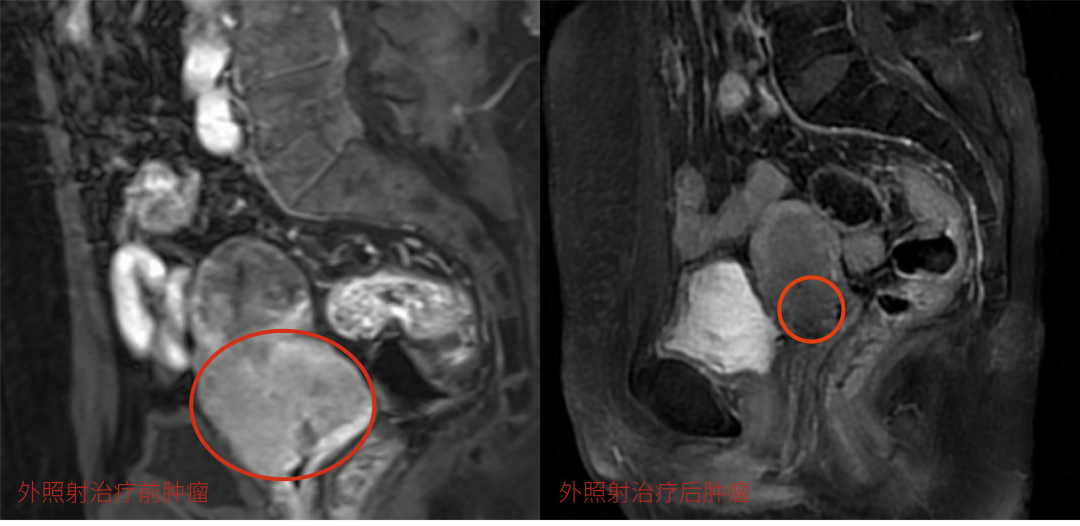 绝经 7 年又出血，一查竟是 5 厘米宫颈肿瘤！肿瘤这么大医生为什么不手术？