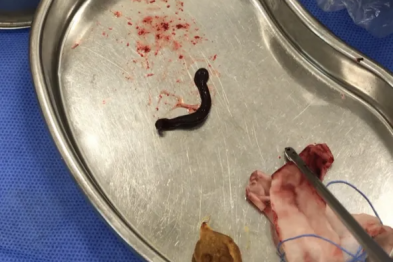 桂林男子鼻喉取出 3 条蚂蟥！医生提醒：野外活动千万别大意