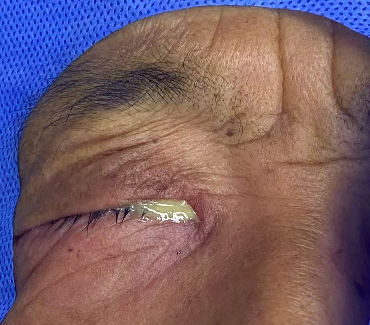 泪囊炎有哪些症状？挤压内眼角有脓性分泌物，是泪囊炎吗？