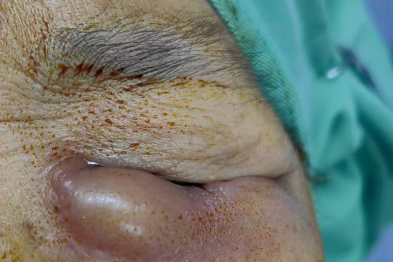 泪囊炎有哪些症状？挤压内眼角有脓性分泌物，是泪囊炎吗？