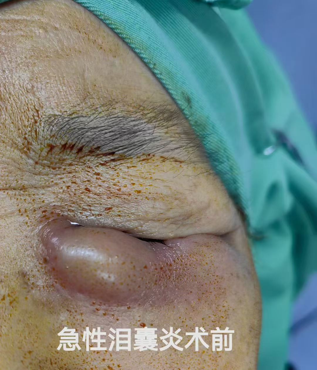 泪囊炎有哪些症状？挤压内眼角有脓性分泌物，是泪囊炎吗？