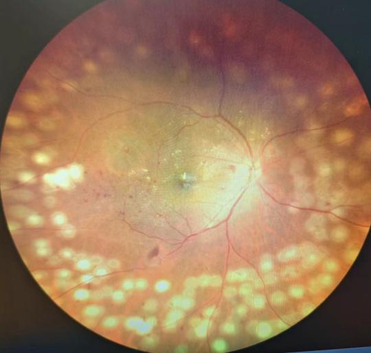 糖尿病盯上「眼底」，警惕这些致盲隐患！