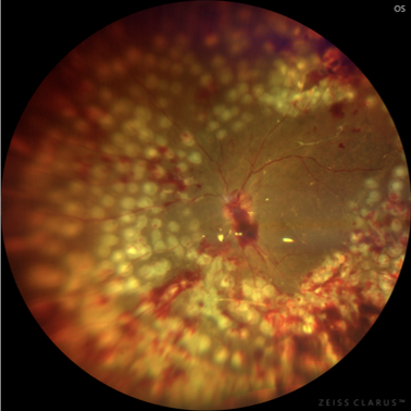 糖尿病盯上「眼底」，警惕这些致盲隐患！