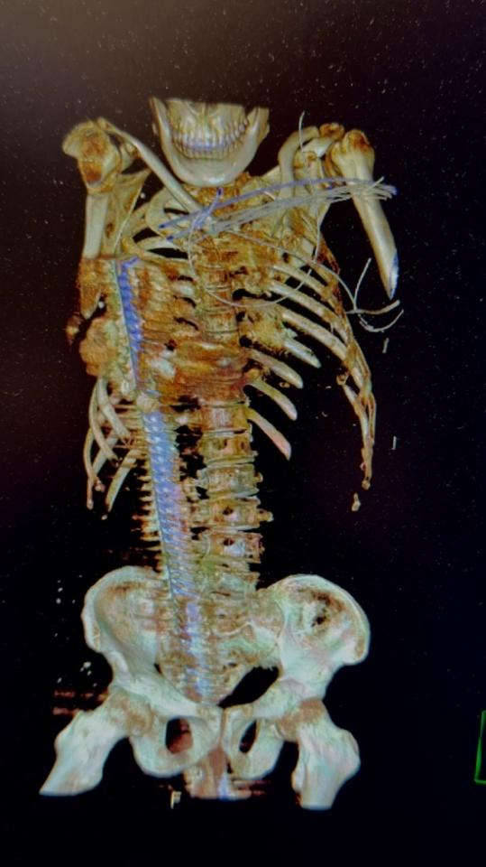 医患双向奔赴:钢筋穿身历生死,再赴江北续仁心