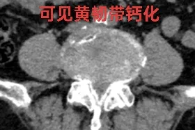 腰椎管狭窄不用怕！UBE 微创技术，为 83 岁老人解锁「无痛行走」