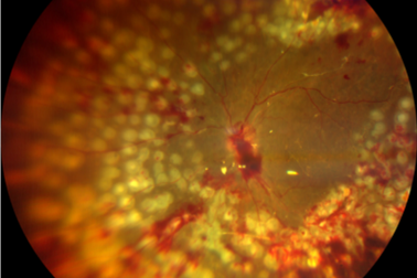 糖尿病盯上「眼底」，警惕这些致盲隐患！