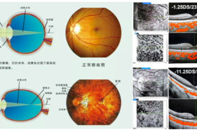 给高度近视的眼球系一条「安全带」：关于后巩膜加固术，家长需要知道的几件事