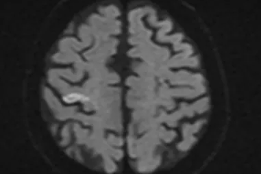 「年纪太大不敢溶栓」？90 岁卒中患者 48 小时重获行走能力