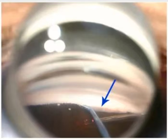 管中窥豹、雾里看花！南科大医院微创手术为青光眼老人带来清晰「视界」