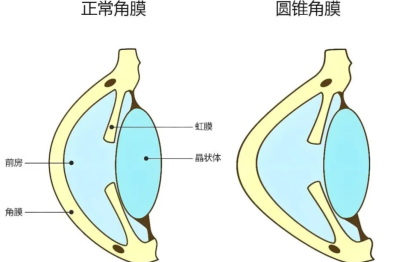 关于圆锥角膜，青少年致盲的「隐形杀手」