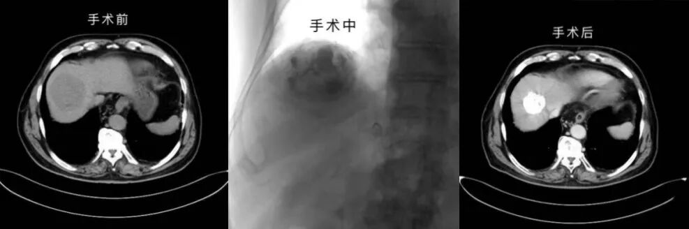 国文医院微创介入手术成功救治 80 岁原发性肝癌患者