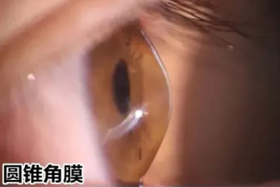 视力 0.02 误以为近视，两位年轻人在辽宁爱尔眼科确诊圆锥角膜，警惕这种致盲性眼病