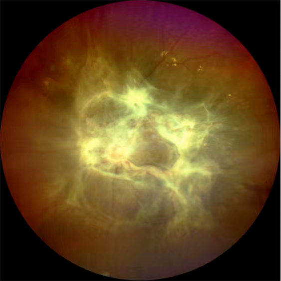 糖尿病盯上「眼底」，警惕这些致盲隐患！