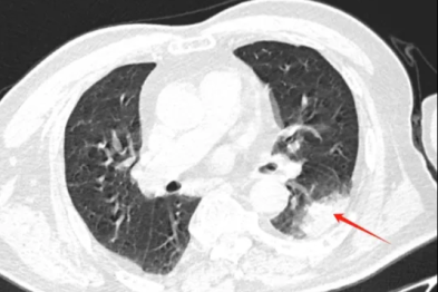 腹痛腹泻竟是「鸟传人」重症感染！江北医院 ICU 精准破局