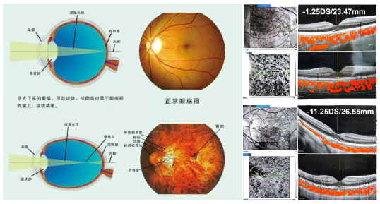 给高度近视的眼球系一条「安全带」：关于后巩膜加固术，家长需要知道的几件事