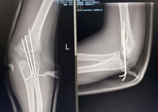 孩子肘骨折，别急着「开刀」！