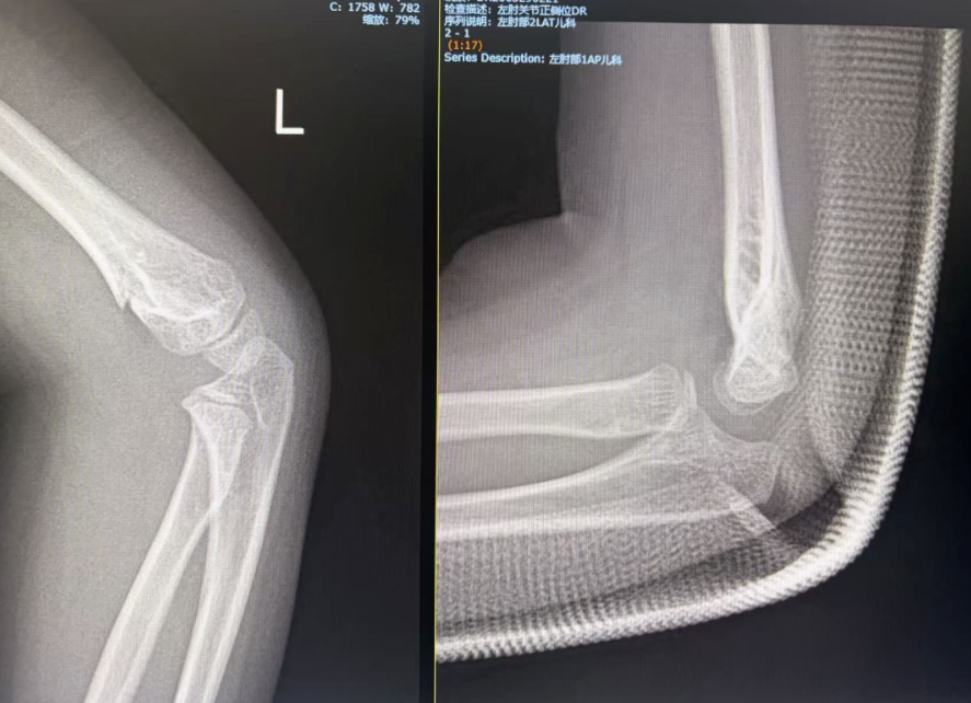 孩子肘骨折，别急着「开刀」！