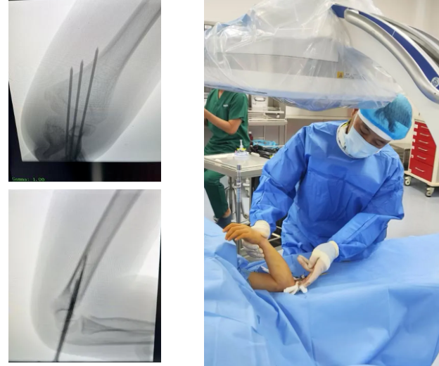 孩子肘骨折，别急着「开刀」！