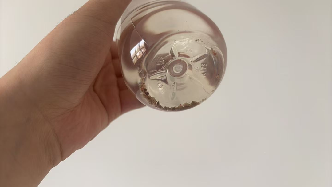 排尿排出「金豆子」！0.9 cm 输尿管结石，不开刀体外冲击波碎石