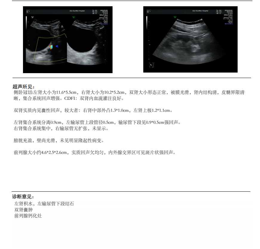 排尿排出「金豆子」！0.9 cm 输尿管结石，不开刀体外冲击波碎石