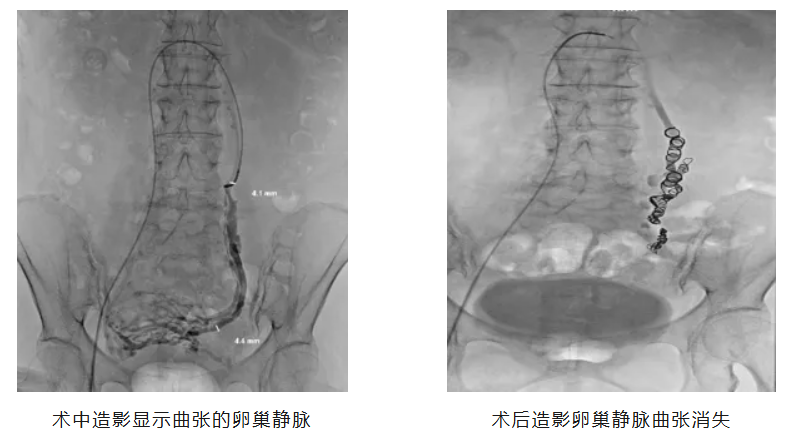盆腔淤血综合征——久治不愈的"妇科病"，原来是血管在作怪！