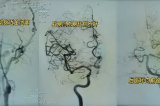 取栓途中遭遇长段夹层，看如何力挽狂澜