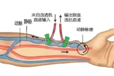 透析患者的「针眼」奇迹 | 正兴这项新技术让狭窄内瘘当场再通