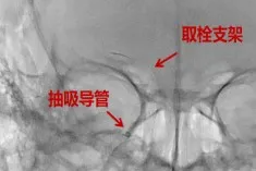 突破时间壁垒——西安市第三医院神经内科成功救治发病超 24 小时急性脑动脉闭塞患者