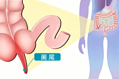 有一种肚子痛，会转移阵地！早发现、早治疗，才能少遭罪！