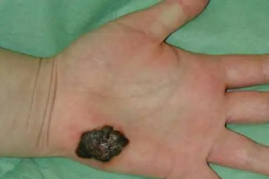 25 岁确诊恶性黑色素瘤！你身上的痣安全吗？对照速查这几点